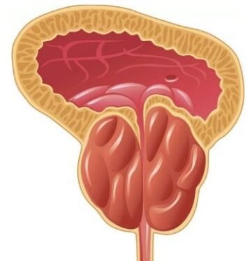 Inflammation de la prostate