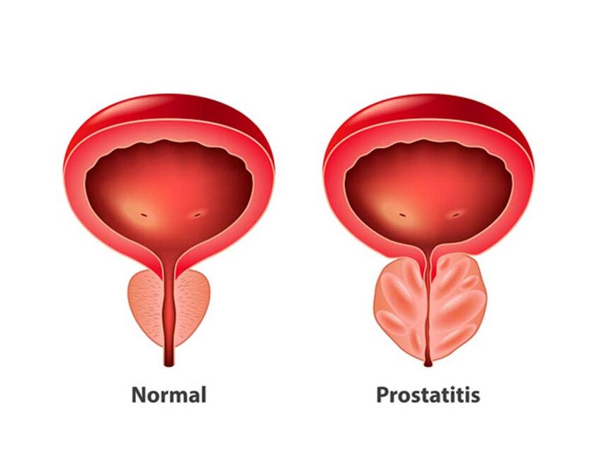 Prostate normale et inflammatoire