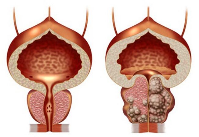 prostate saine et adénome prostatique