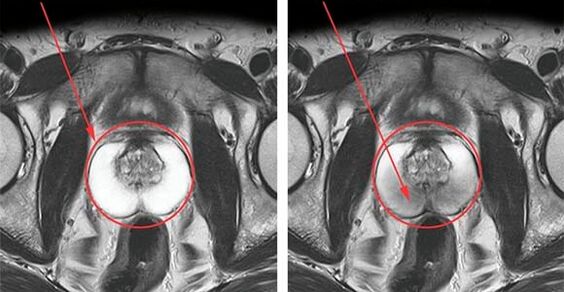 Prostate normale (à gauche) et prostate enflammée avec prostatite (à droite)